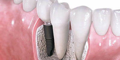 implantaterteaser
